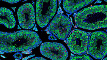Vliv diabetu na neplodnost, rozhovor s Gabrielou Pavlínkovou pro ČT24