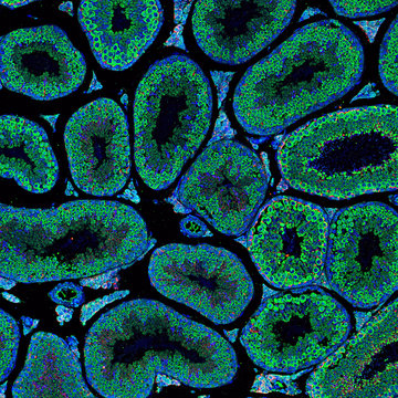 Vliv diabetu na neplodnost, rozhovor s Gabrielou Pavlínkovou pro ČT24
