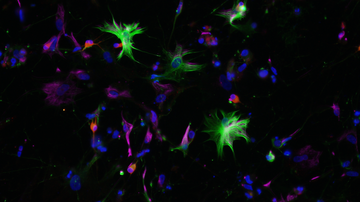 Mezinárodní vědecké konsorcium pracuje na objasnění mechanismu ultra-vzácné Alexandrovy choroby