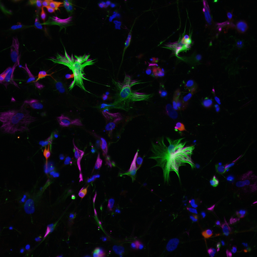 Mezinárodní vědecké konsorcium pracuje na objasnění mechanismu ultra-vzácné Alexandrovy choroby