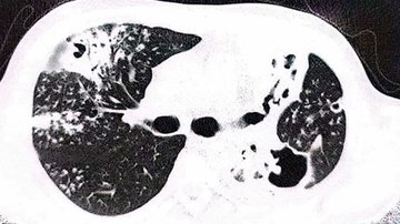 Houbu objevenou v plících pacienta pojmenovali po českém vědci