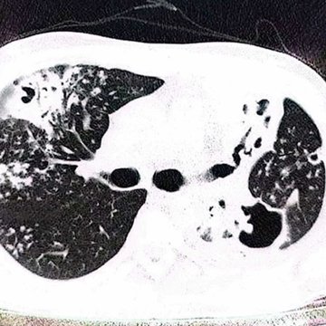 Houbu objevenou v plících pacienta pojmenovali po českém vědci